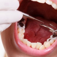 Your Questions Answered About A Dental Crown Procedure In Kona