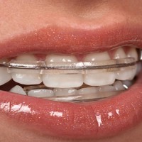 Why a Sleep Dentist Could Be Right for You