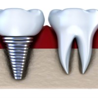 Dental Implants in Kalamazoo MI Can Greatly Improve a Person’s Smile
