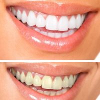 Teeth Whitening for Whiter Teeth and a Beautiful Smile