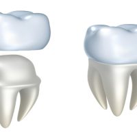Dental Implants In Sydney: The Advantages