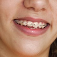 Advantages Offered by Invisalign in Annapolis Over Traditional Braces