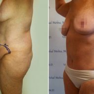 Things You Need to Know About Having a Tummy Tuck