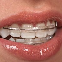 Invisalign: What to Know Before You Get Those Trays