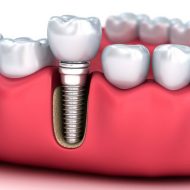 Restore Your Smile with Dental Implants