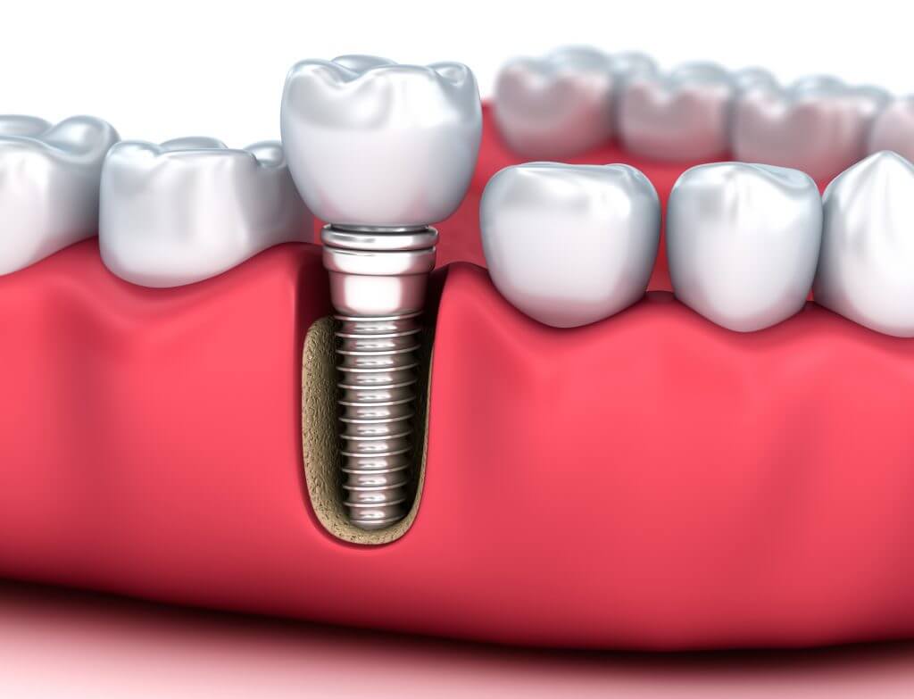 Restore Your Smile with Dental Implants