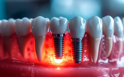 Choosing the Right Dental Bridges in Melbourne FL for Your Needs