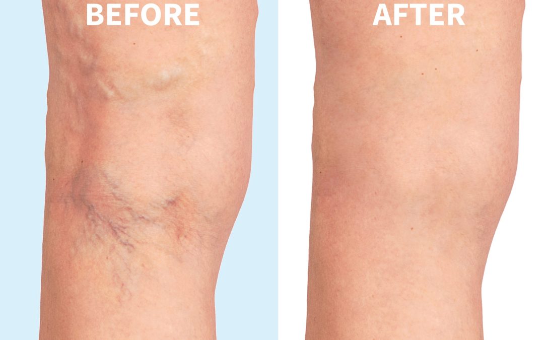 Managing Leg Swelling in Hoffman Estates IL with Expert Guidance for Improved Mobility